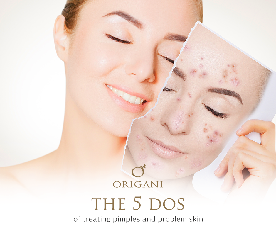 The 5 Do’s Of Treating Acne